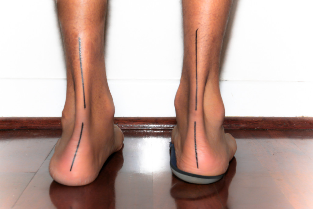 Custom foot orthotics correcting foot posture