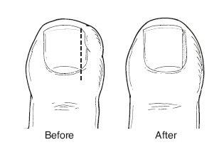 Before and after treatment of ingrown toenails