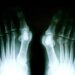 Looking for Minimally Invasive Bunion Surgery in Perth?